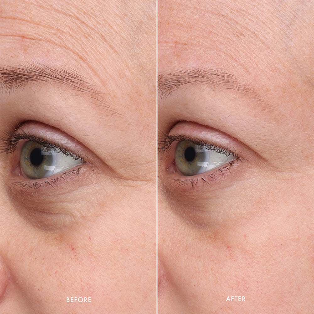 Before and after comparison of a woman's eye area with visible skin texture and lines.